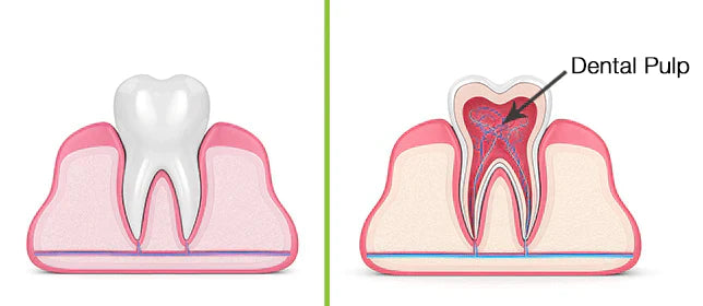 ღრძილების ანთება - პულპიტი